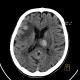 Metastatic disease of the brain: CT - Computed tomography